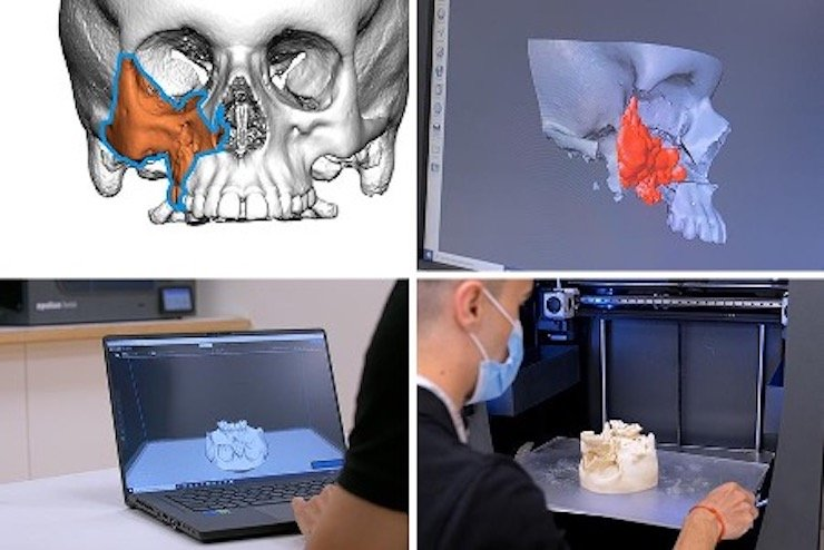 巴塞罗那医院利用3D技术规划和模拟切除肿瘤并挽救儿童的眼睛