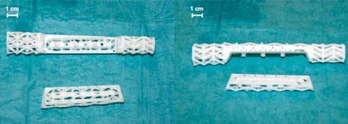 3D打印支架用于治疗枪伤患者